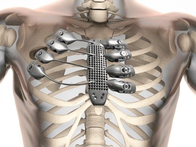 Първата в света 3D принтирана протеза на гръдния кош